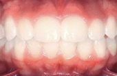 front and bottom teeth after metal braces
