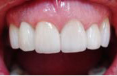 After Tooth Replacement