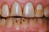 Before Veneers